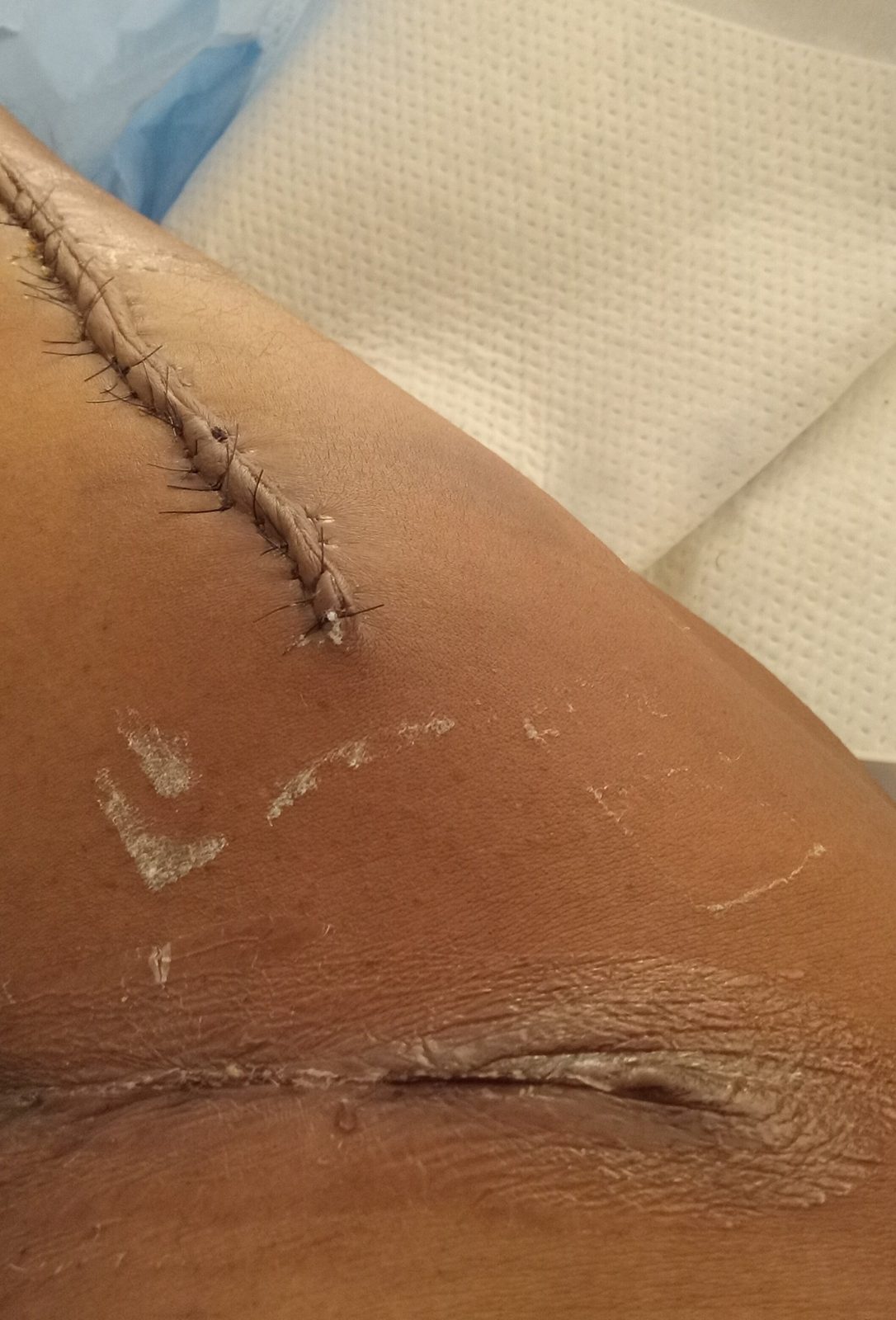 Surgery Recovery Close-Up