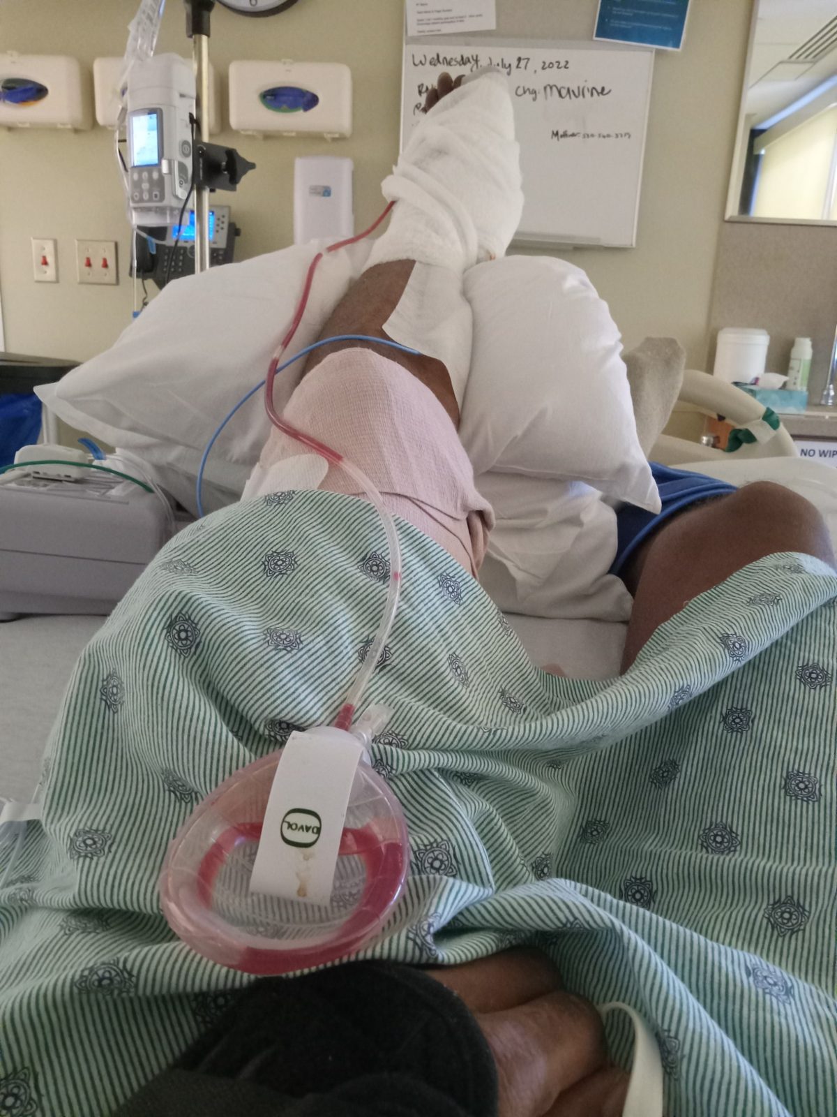 Post-Surgery Leg Recovery