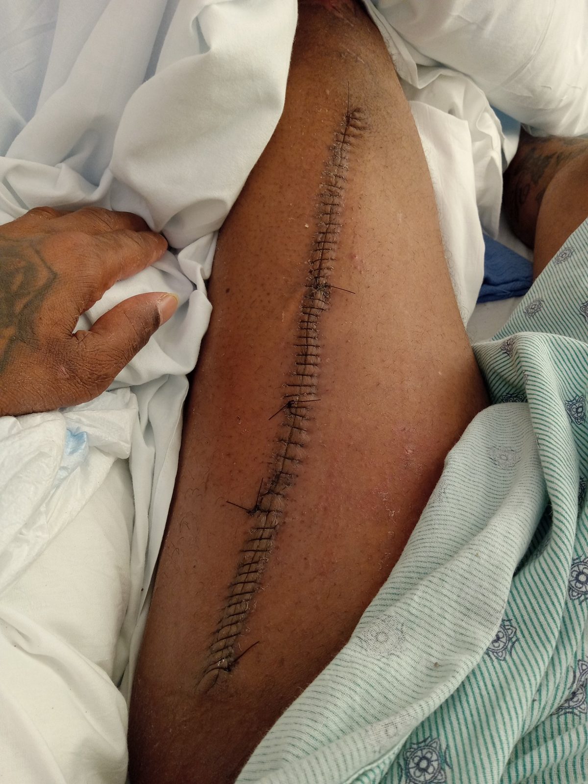 Cast And Trauma Recovery